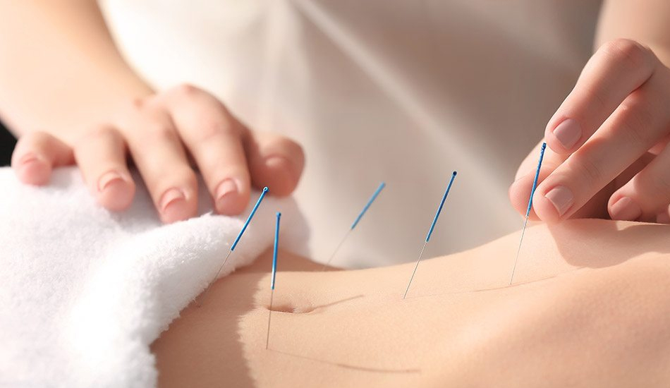 tratamentul acupuncturii varicoză